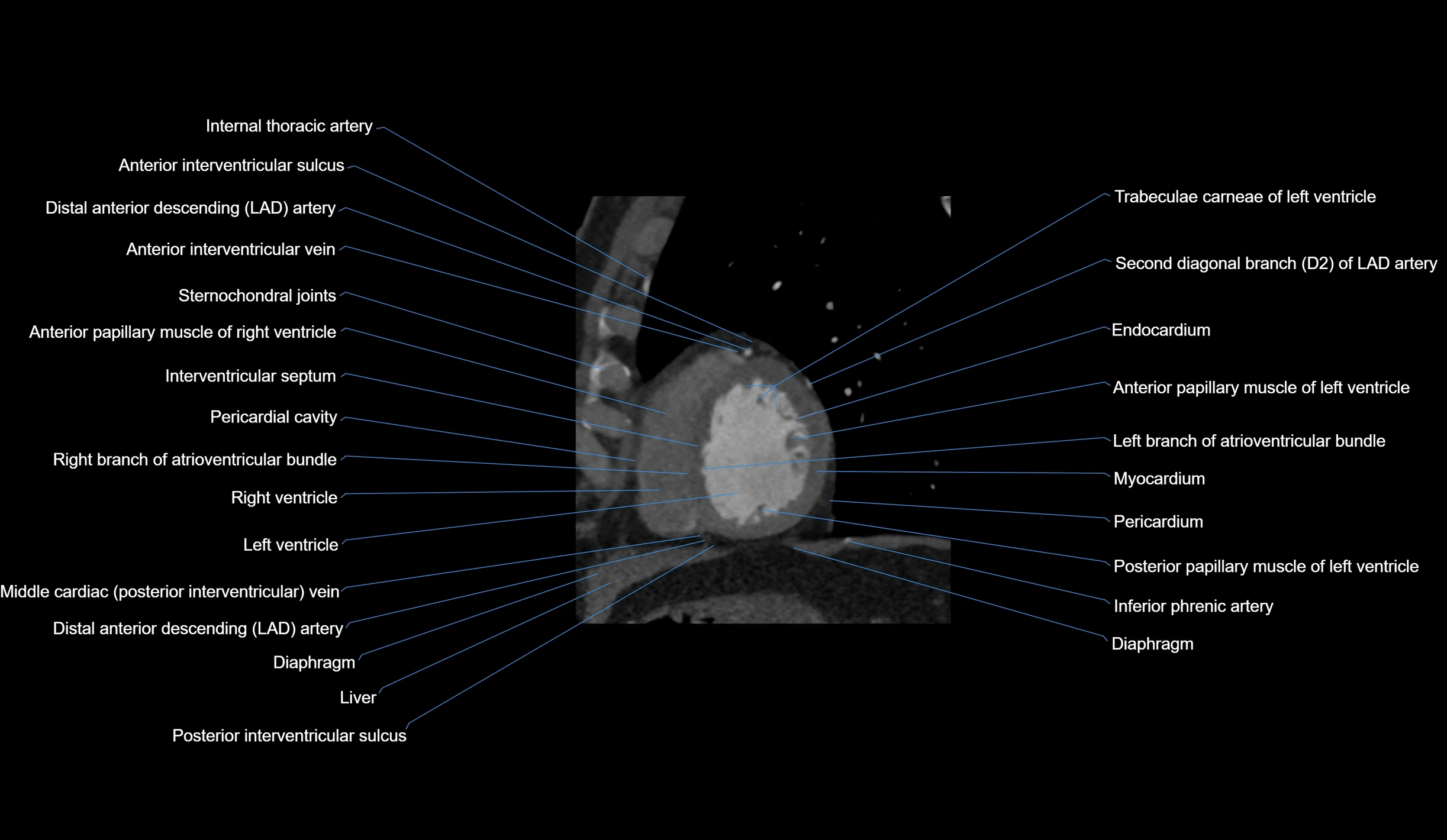 CT heart (coronary angiogram) short axis view  cross sectional anatomy labelled radiology image-00040.webp